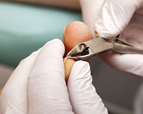 Tratamento para Unha encravada