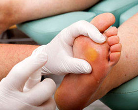 Tratamento para Calo com Núcleo