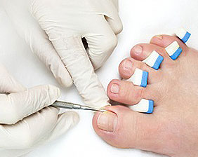 Tratamento de Micose de unha